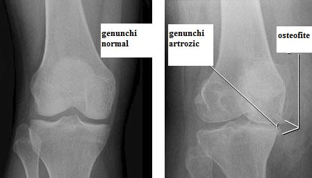 Gonartroza - Artroza genunchi Gonartrozagonartroza Gonartroza - Artroza genunchi Gonartroza