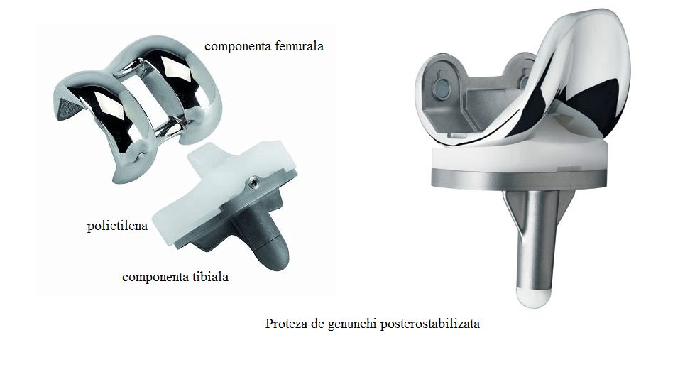 proteza-genunchi Artroplastie Genunchiartroplastie genunchi Artroplastie Genunchi