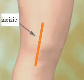 recuperare-postoperatorie Artroplastie Genunchiartroplastie genunchi Artroplastie Genunchi